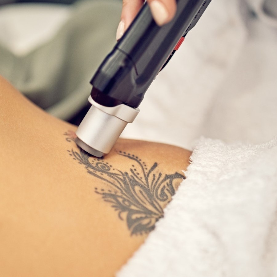 Cost of Tattoo Removal