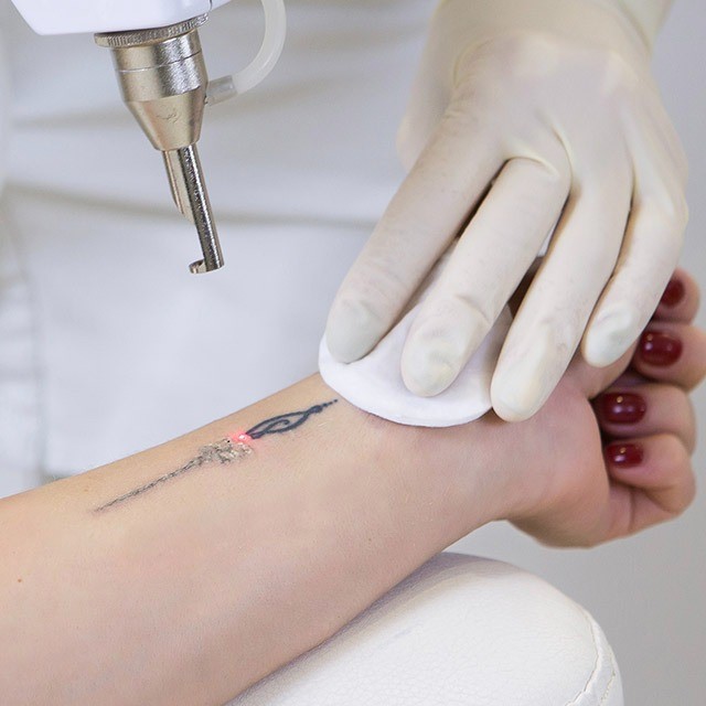 Cost of Tattoo Removal